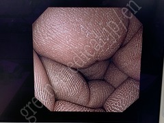 OLYMPUS Video Transnasal Gastroscope