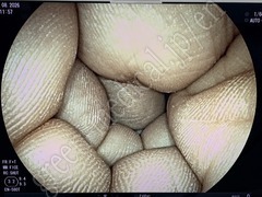 FUJIFILM Double Balloon Endoscope