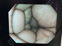 OLYMPUS Video Colonoscope