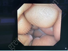 OLYMPUS Nasal Gastroscope