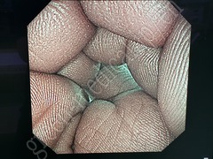 OLYMPUS Nasal Gastroscope