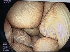 FUJIFILM Video Transnasal Gastroscope