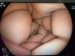 FUJIFILM Video Transnasal Gastroscope