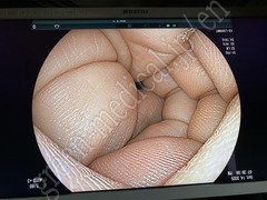 FUJIFILM Video Transnasal Gastroscope